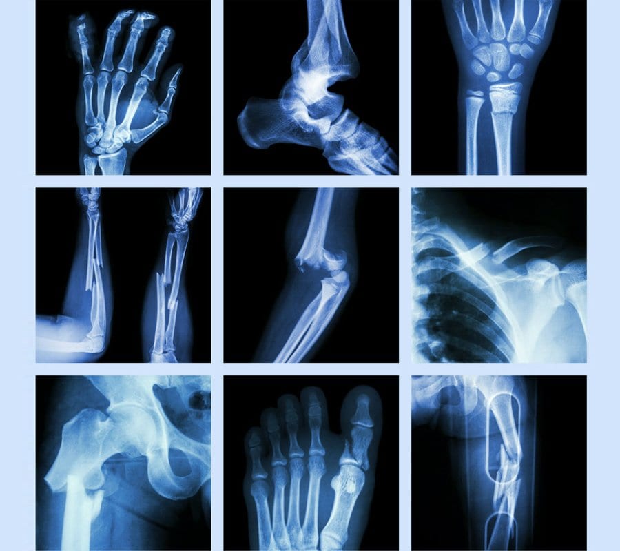 fractures | Treatments at myDoc Urgent Care in Forest Hills, Queens NY