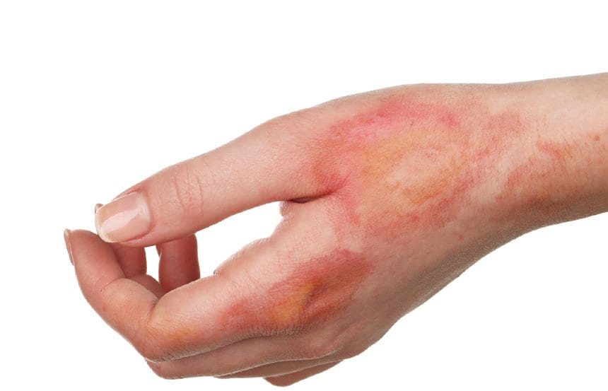 First Degree Burn Treatment at myDoc Urgent Care in Forest Hills, Queens, NY