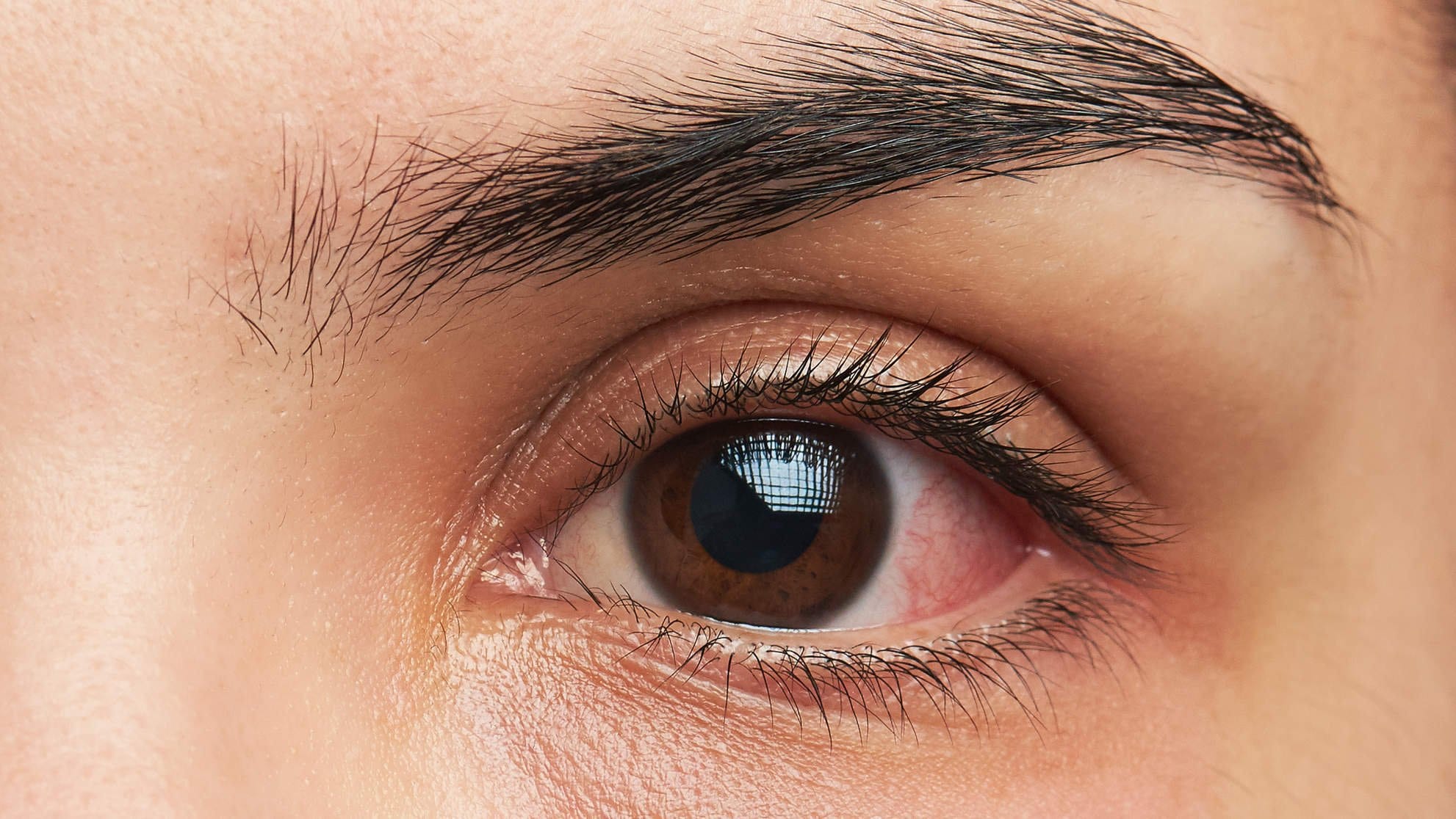 eye with infection | myDoc Urgent Care in Forest Hills, Queens, NY