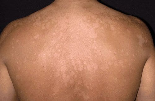 tinea_versicolor_high | Treatments at myDoc Urgent Care in Forest Hills, Queens NY