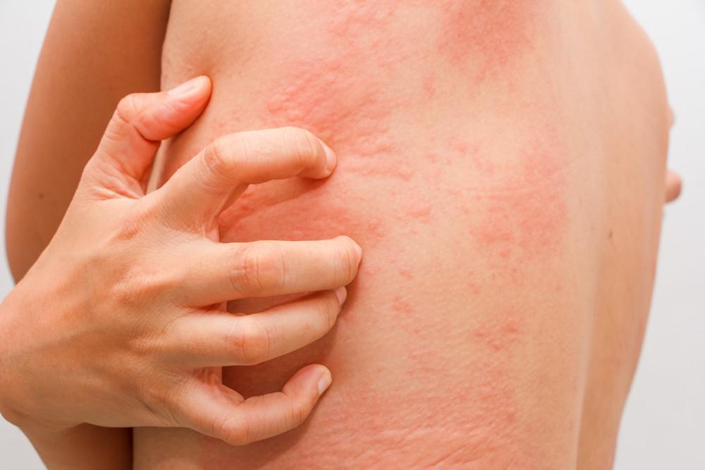Which Type of Allergy Test Do I Need?